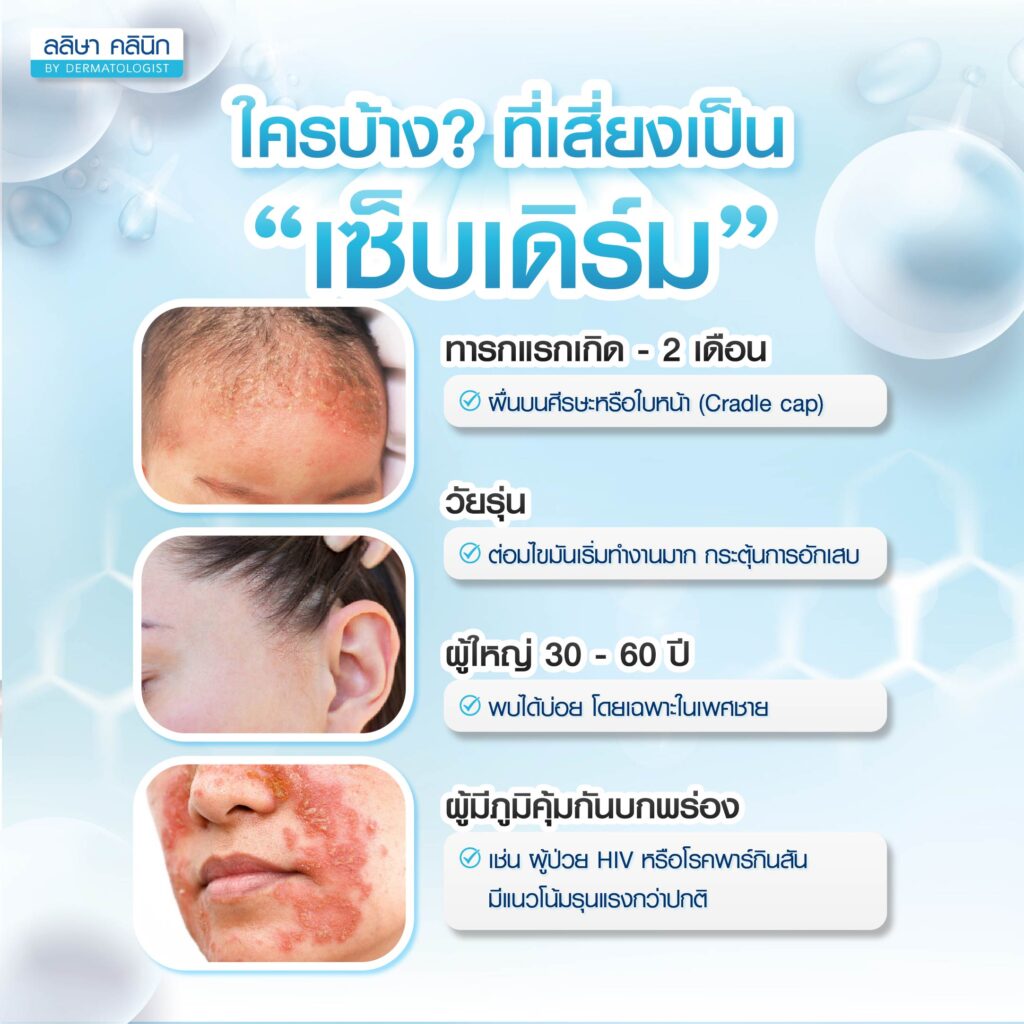 เซ็บเดิร์ม ใครเสี่ยงเป็นบ้าง