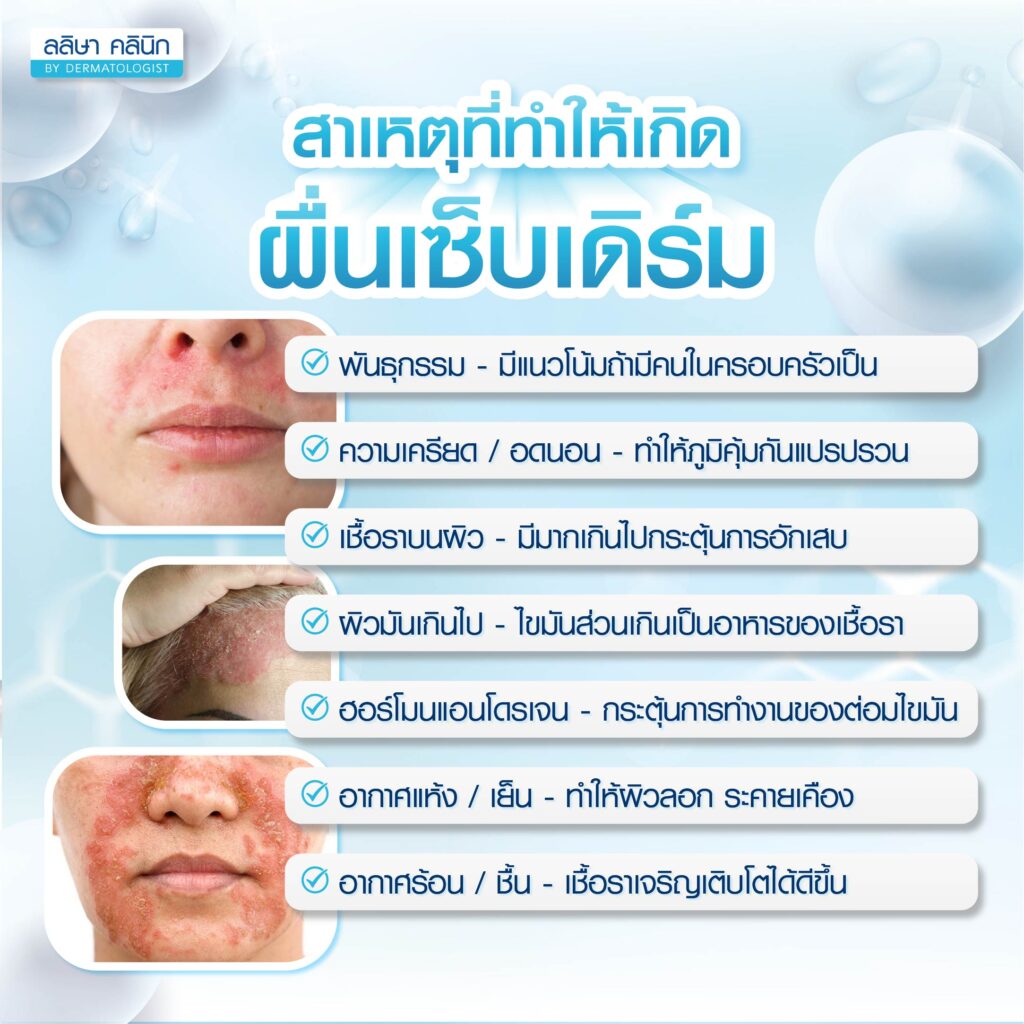 เซ็บเดิร์มเกิดจากอะไร