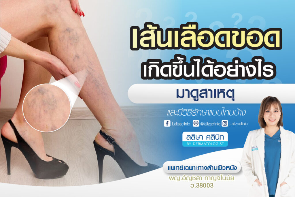 เส้นเลือดขอด คืออะไร อันตรายไหม แนวทางป้องกัน