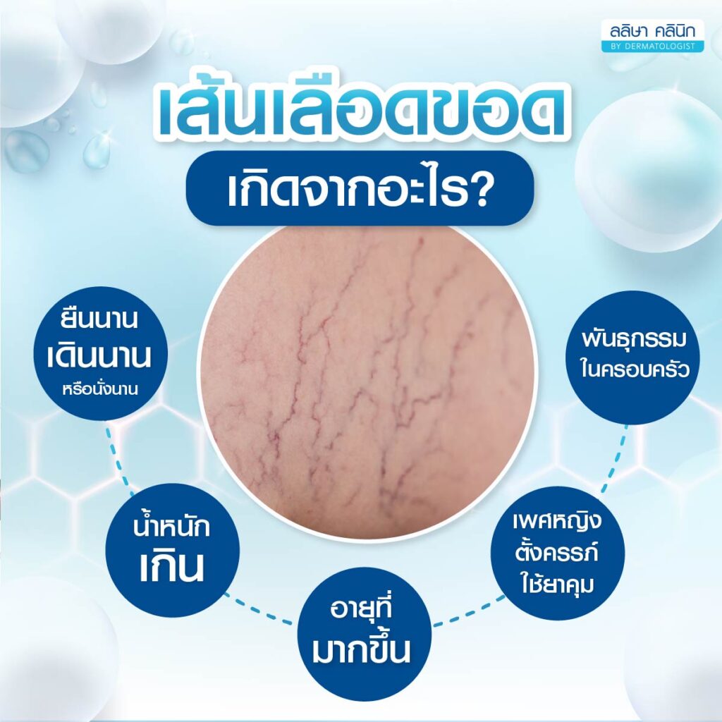 เส้นเลือดขอด เกิดจากอะไร