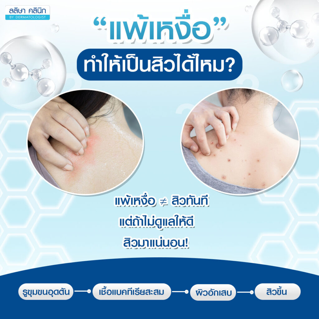แพ้เหงื่อตัวเอง ทำให้เป็นสิวได้ไหม