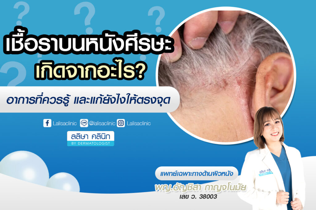 5 วิธีรักษาเชื้อราบนหนังศีรษะ ให้หาย พร้อมวิธีป้องไม่ให้เป็นซ้ำ