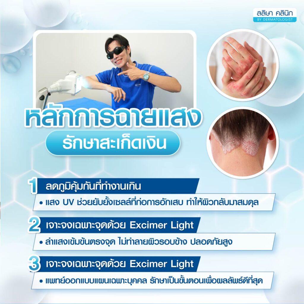 ฉายแสงสะเก็ดเงิน 02
