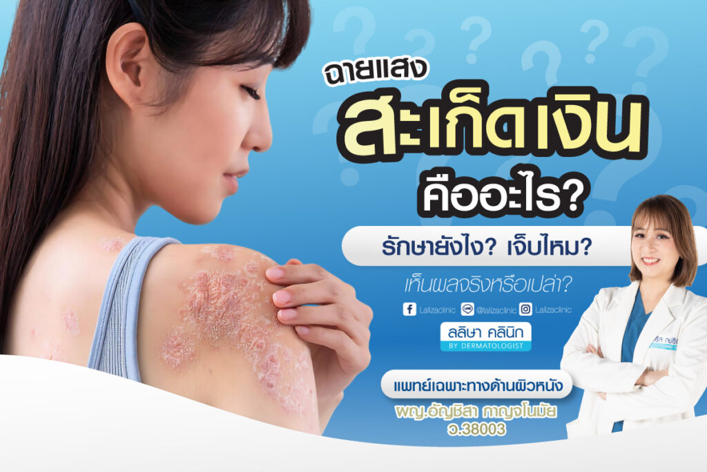 ฉายแสงสะเก็ดเงิน