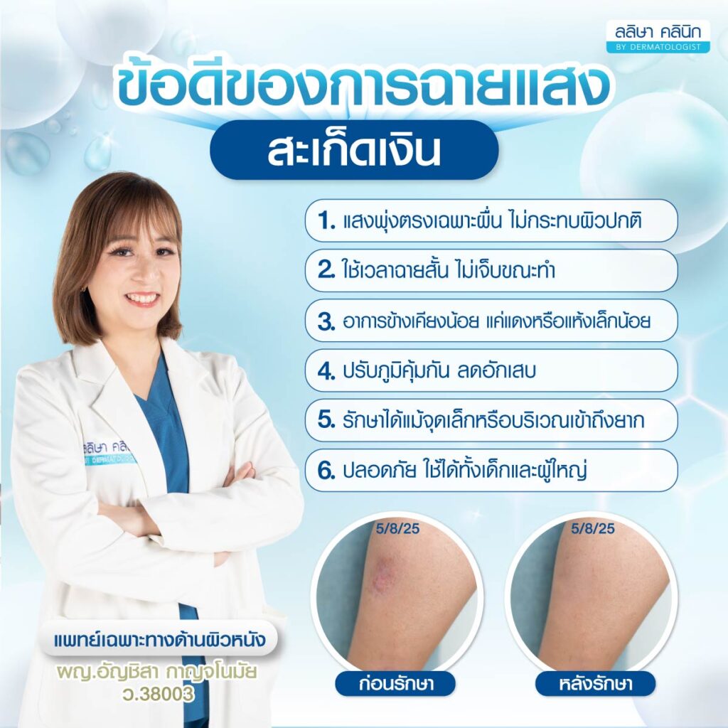 ฉายแสงสะเก็ดเงิน ช่วยอะไร