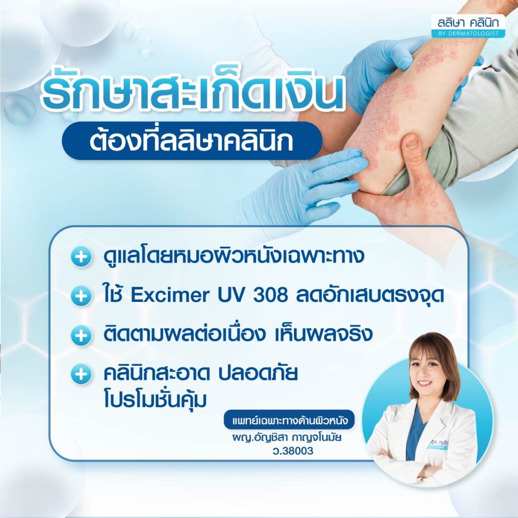 ฉายแสงสะเก็ดเงิน ลลิษาคลินิก