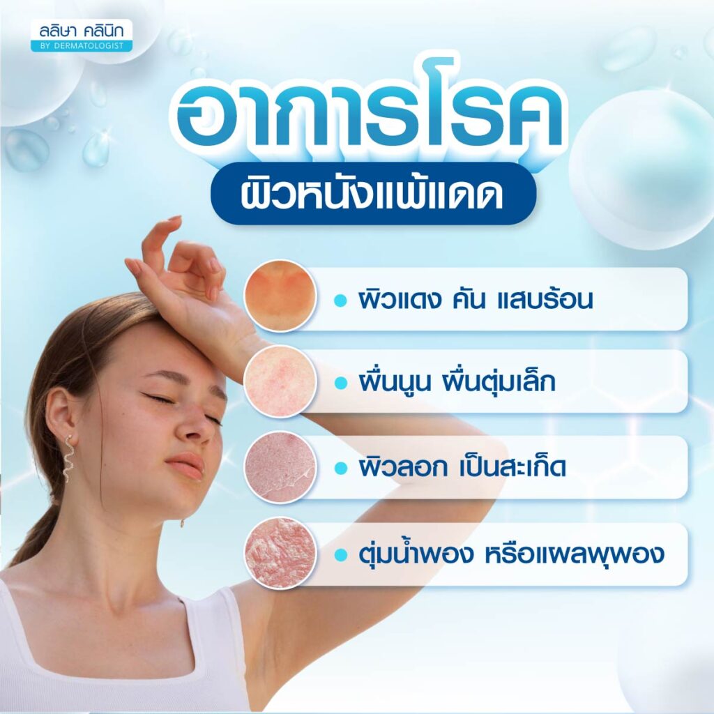 ผิวแพ้แดด อาการ