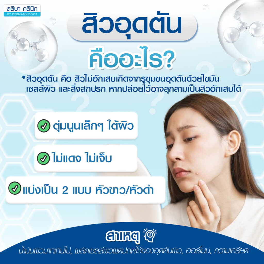 ภาพรายละเอียดสิวอุดตัน