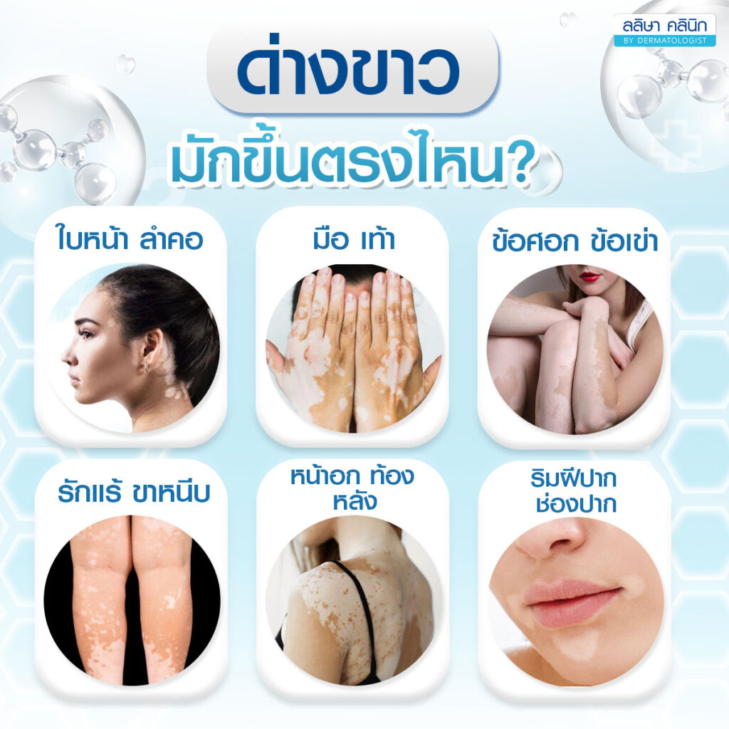 ภาพอธิบายด่างขาวมักขึ้นตรงไหน