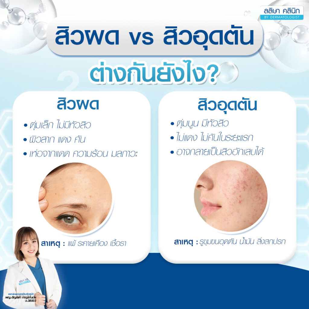 ภาพแสดงการเปรียบเทียบสิวผดกับสิวอุดตัน