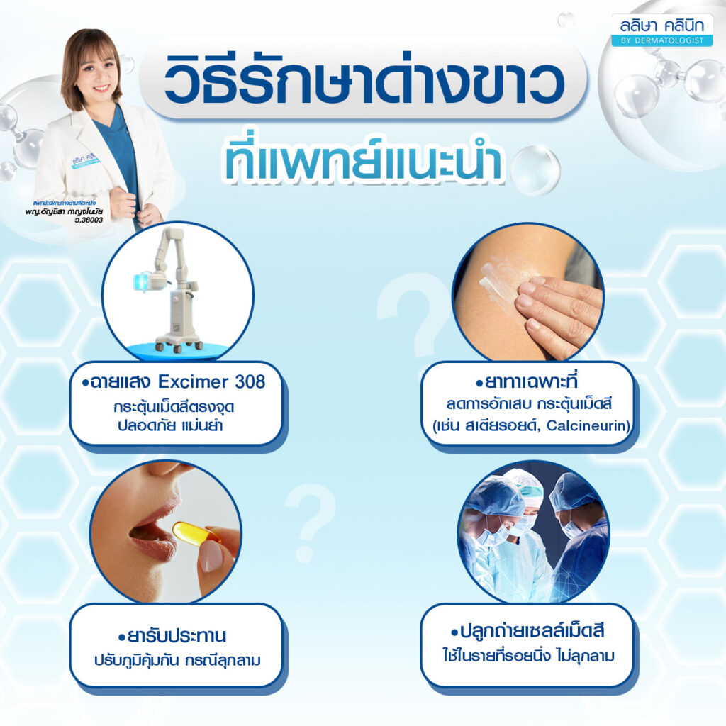 รักษา ด่างขาว