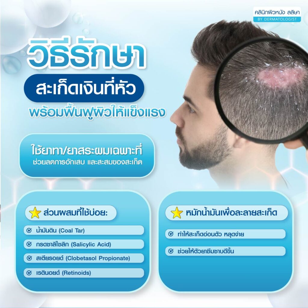 วิธีรักษา สะเก็ดเงินที่หัว