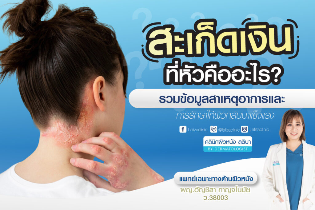 สะเก็ดเงินที่หัว เกิดจากอะไร รักษาด้วยวิธีไหนดี