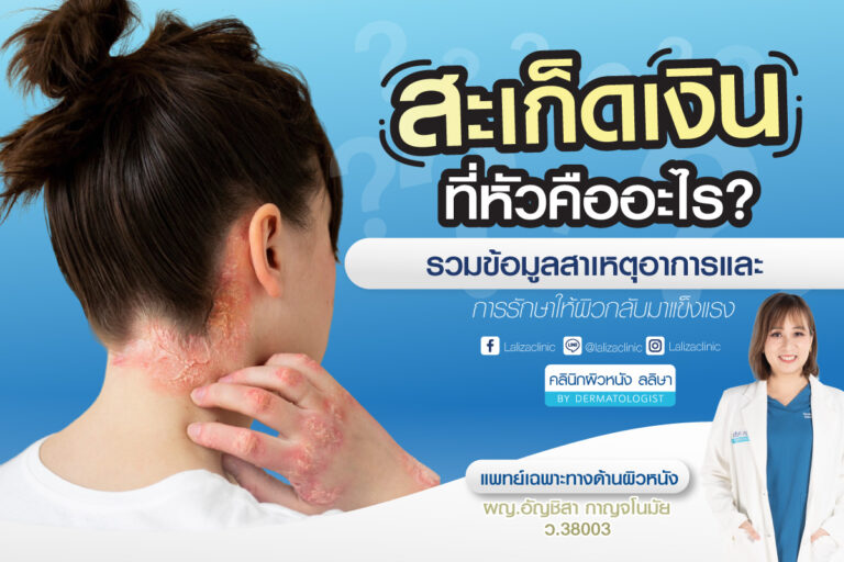 สะเก็ดเงินที่หัว เกิดจากอะไร รักษาด้วยวิธีไหนดี