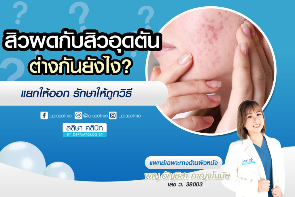 สิวผดกับสิวอุดตันต่างกันยังไง