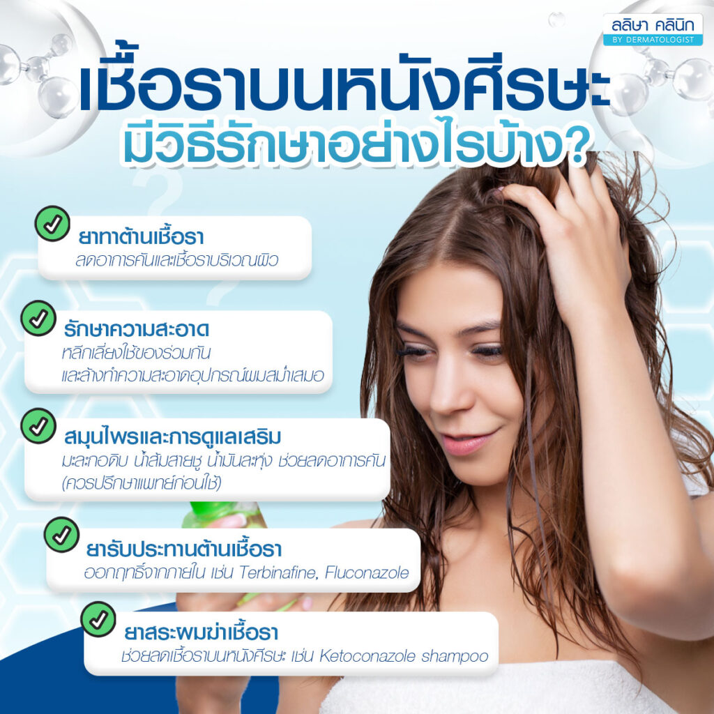 เชื้อราบนหนังศีรษะ วิธีรักษา