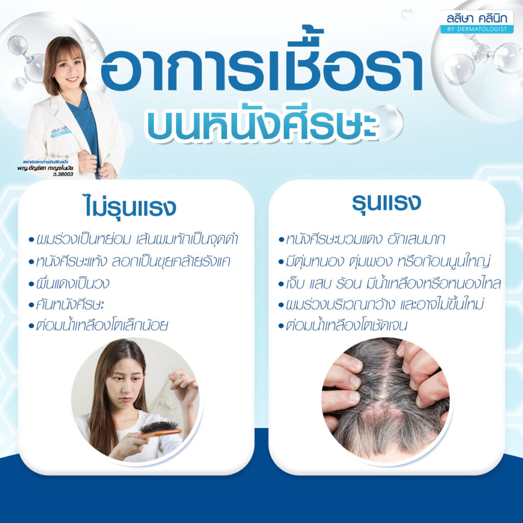 เชื้อราบนหนังศีรษะ อาการ