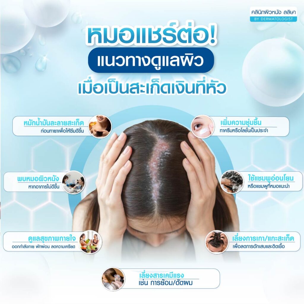 แนวทางดูแลหนังศรีษะเมื่อสะเก็ดเงินที่หัว