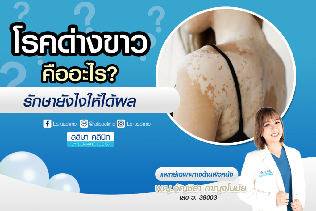 โรคด่างขาว รักษายังไง? เจาะลึกสาเหตุ วิธีดูแลผิวและอาการให้สังเกตเบื้องต้น