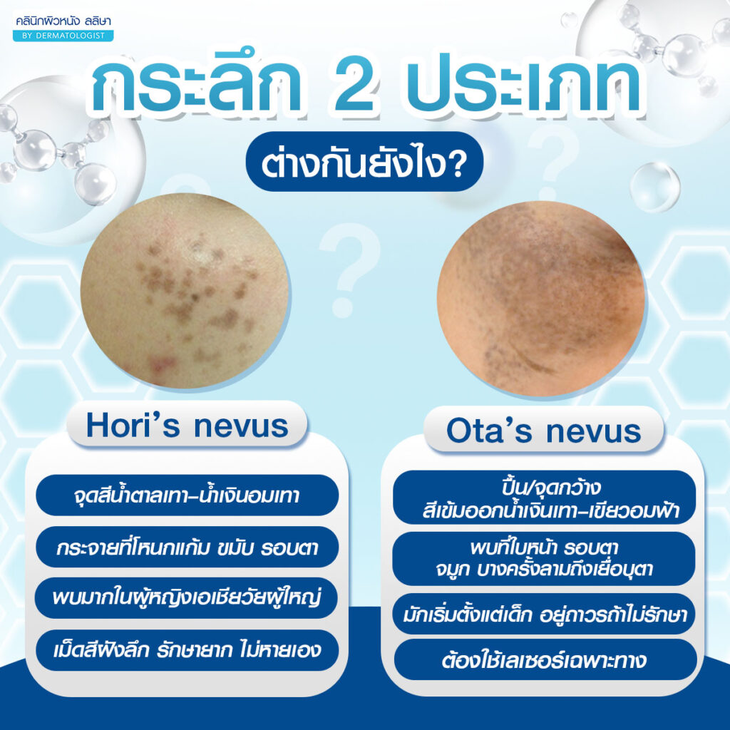 กระลึก 2 ประเภท