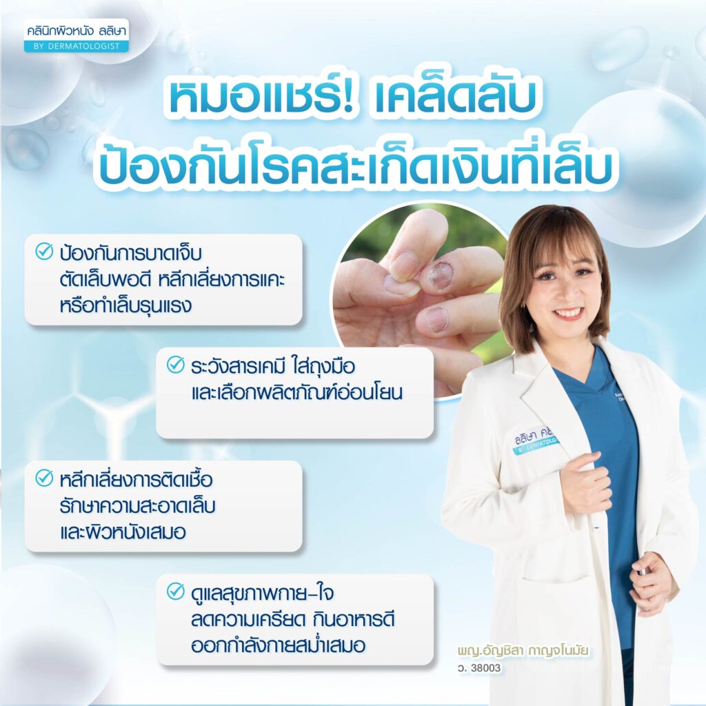 ป้องกัน สะเก็ดเงินที่เล็บ