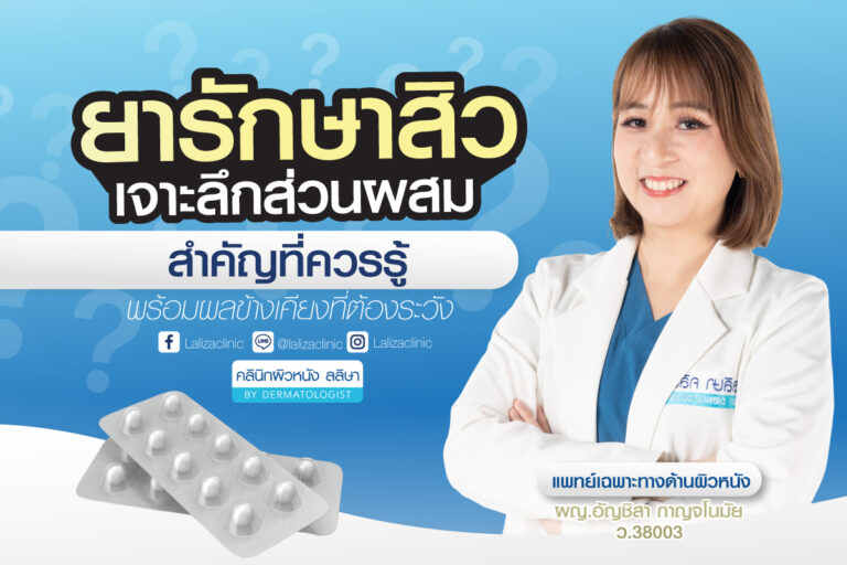 ยารักษาสิว มีแบบไหนบ้าง ใช้แล้วหายขาดจริงไหม