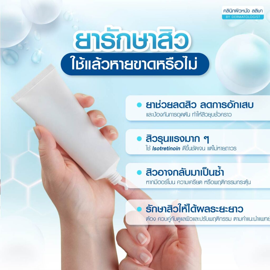 ยารักษาสิว ใช้แล้วหายจริงไหม