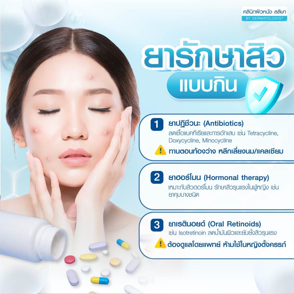 ยารักษาสิวแบบกิน