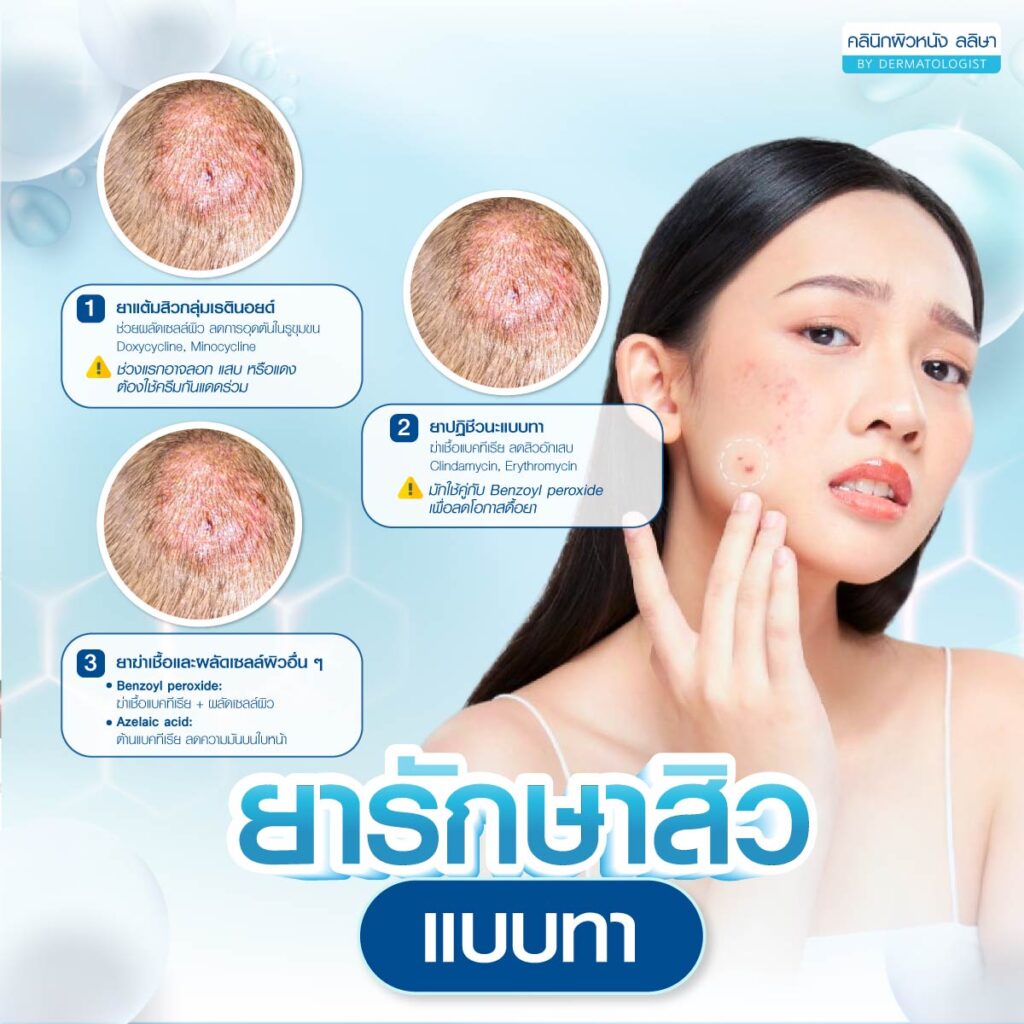 ยารักษาสิวแบบทา