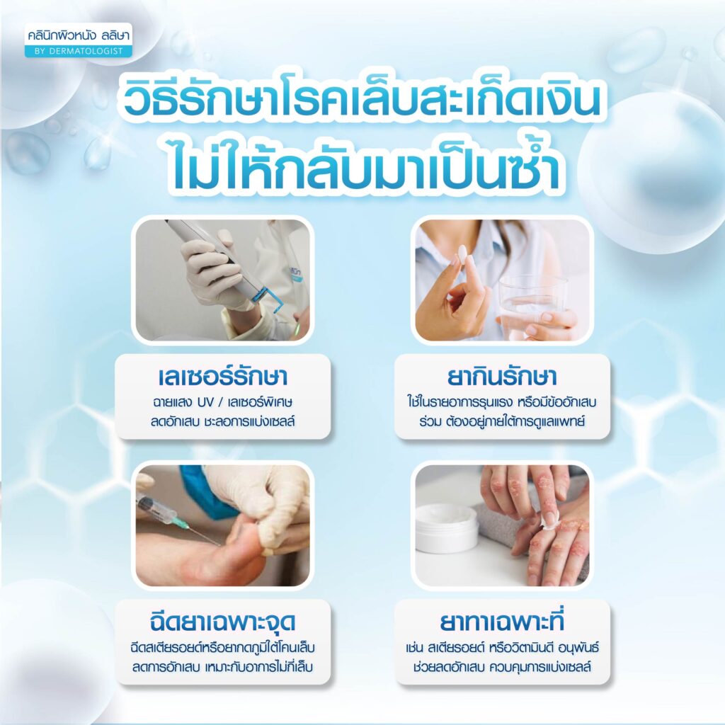 รักษา โรคสะเก็ดเงินที่เล็บ
