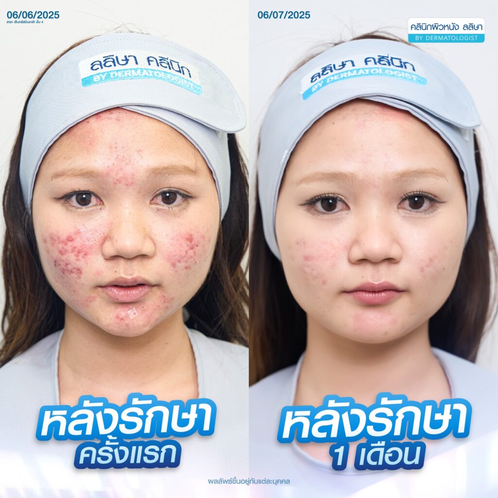 รีวิวคอร์สรักษาสิว (02)
