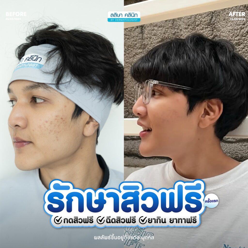 รีวิวคอร์สรักษาสิว (03)