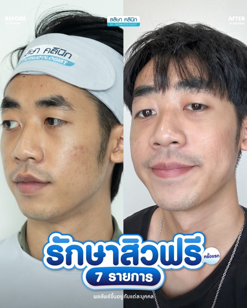 รีวิวคอร์สรักษาสิว (04)