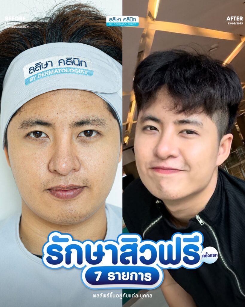 รีวิวคอร์สรักษาสิว (05)