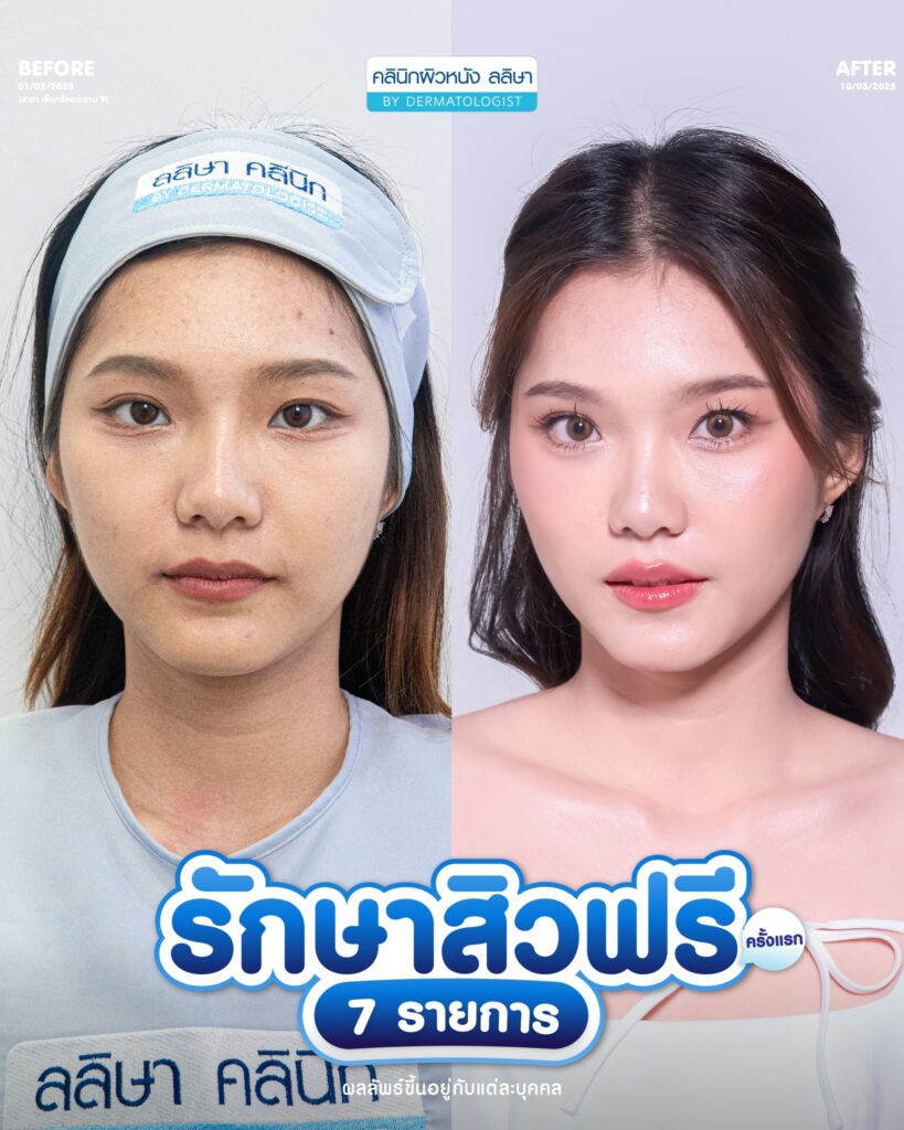 รีวิวคอร์สรักษาสิว