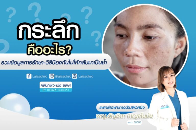วิธีรักษากระลึก และวิธีป้องกันให้ไม่กลับมาเป็นซ้ำ