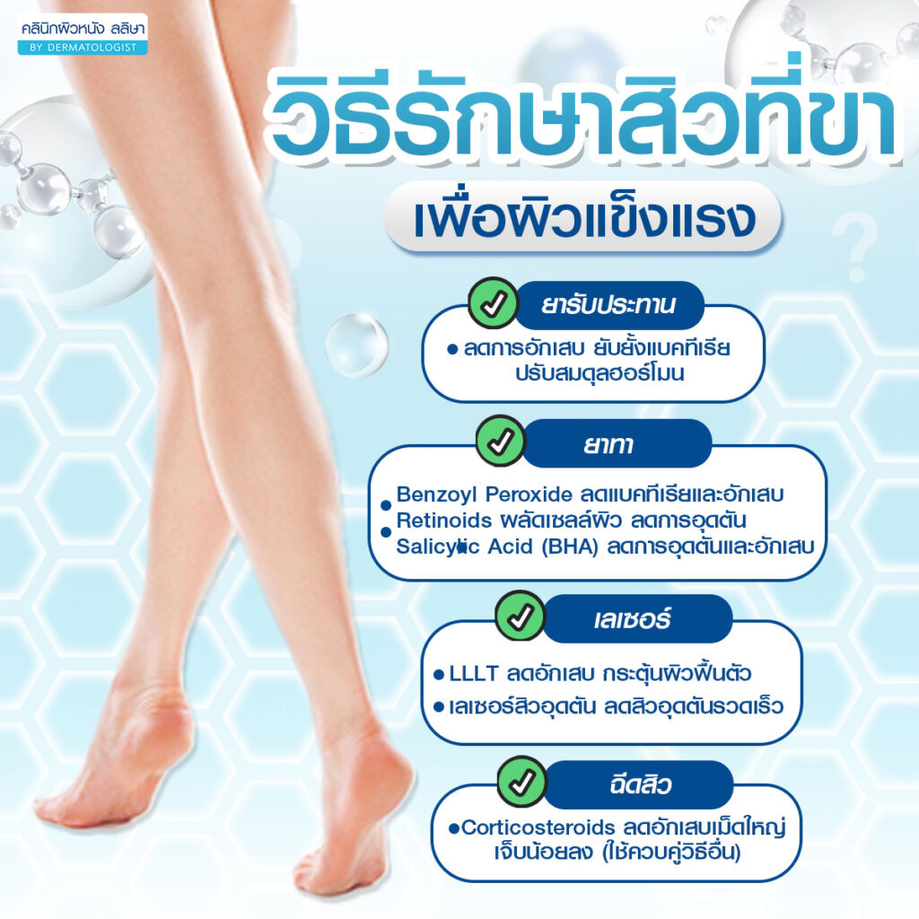 วิธีรักษาสิวที่ขา