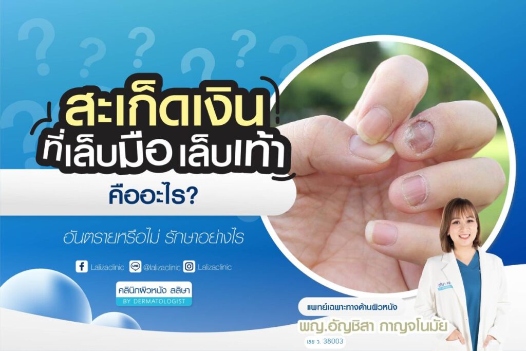 สะเก็ดเงินที่เล็บ ทั้งมือและเท้าเกิดจากอะไร อันตรายหรือไม่ รักษายังไงให้ได้ผล