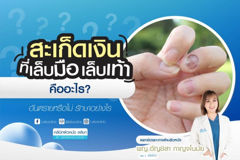 สะเก็ดเงินที่เล็บ ทั้งมือและเท้าเกิดจากอะไร อันตรายหรือไม่ รักษายังไงให้ได้ผล