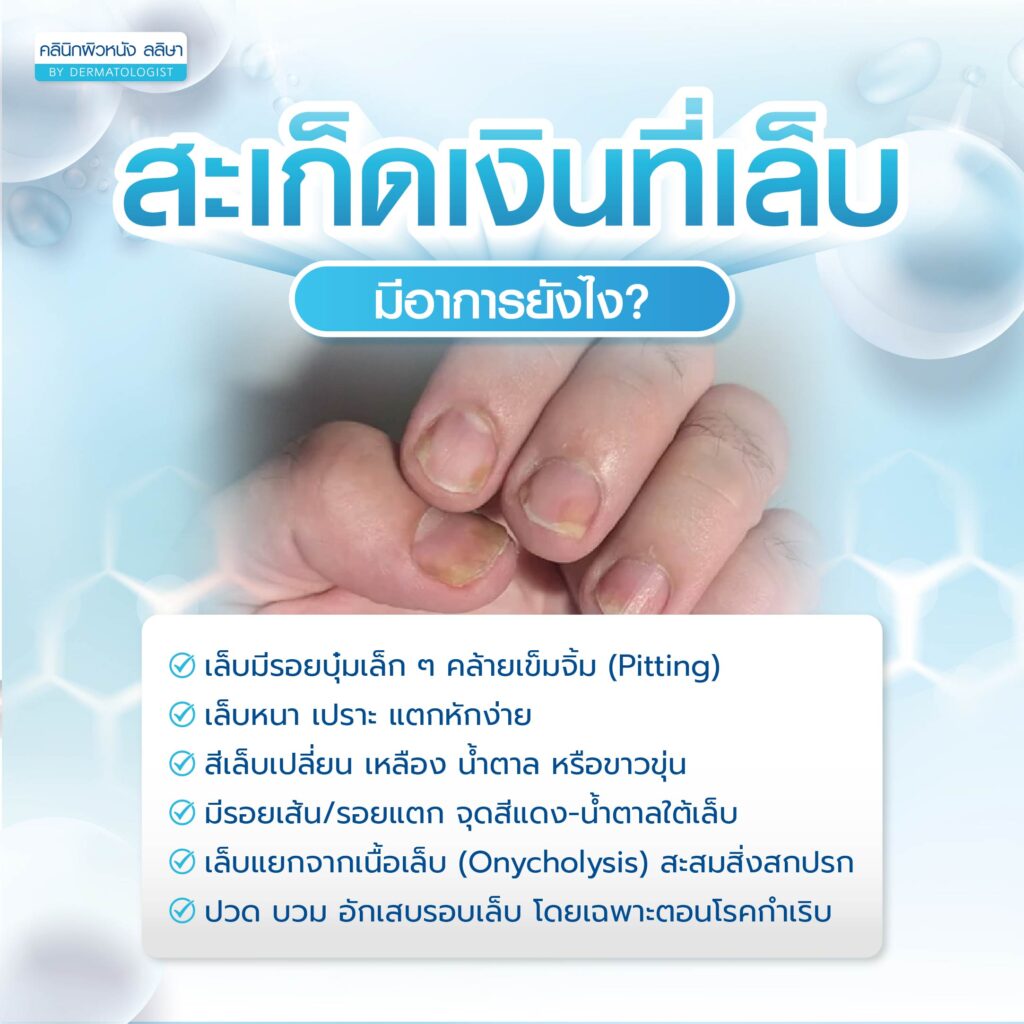 สะเก็ดเงินที่เล็บ อาการ