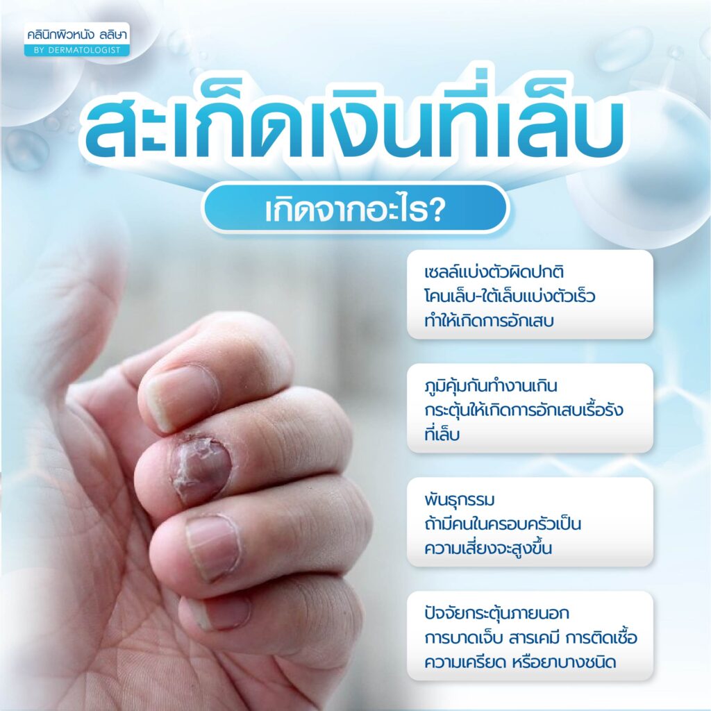 สะเก็ดเงินที่เล็บ เกิดจาก