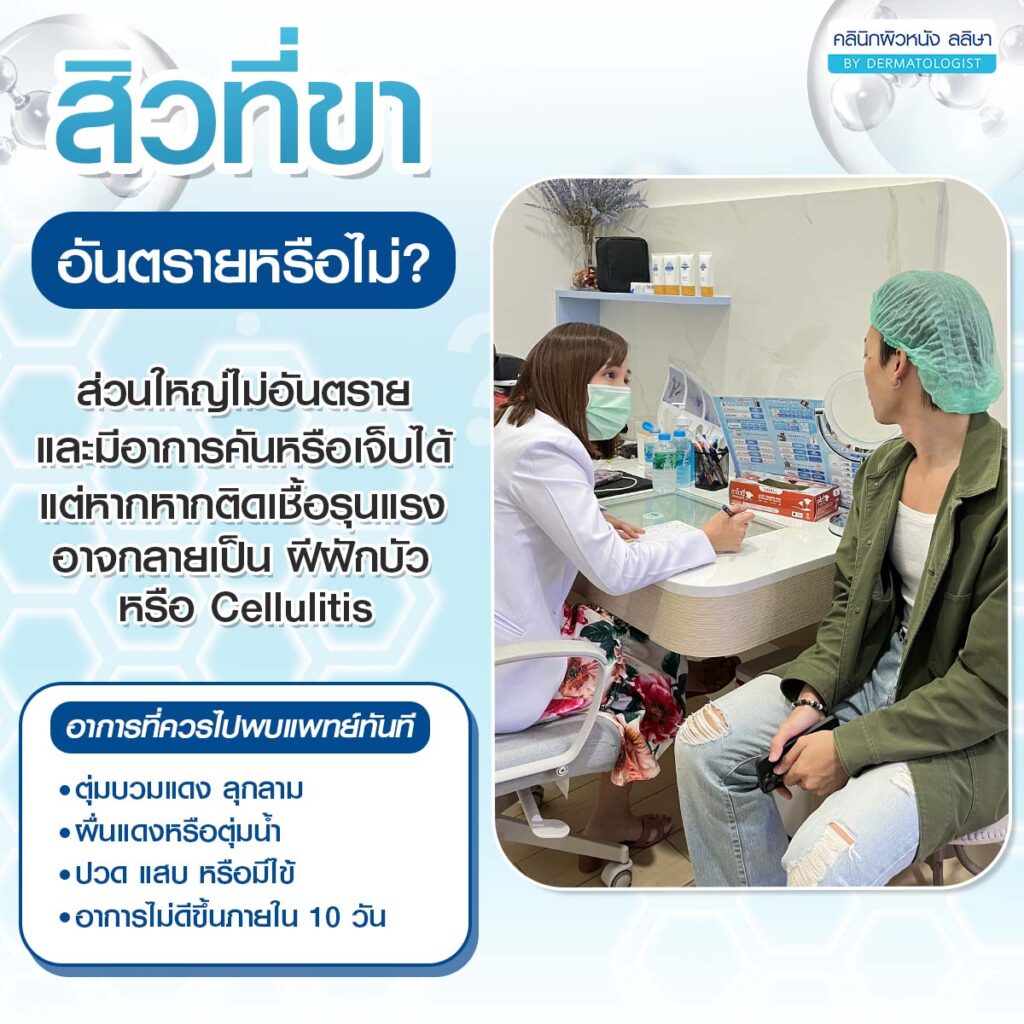 สิวที่ขา อันตรายหรือไม่