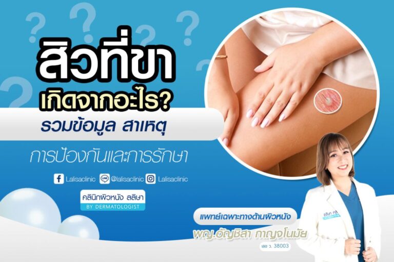 สิวที่ขา เกิดจากอะไร รวมข้อมูลสาเหตุ การป้องกันและการรักษา