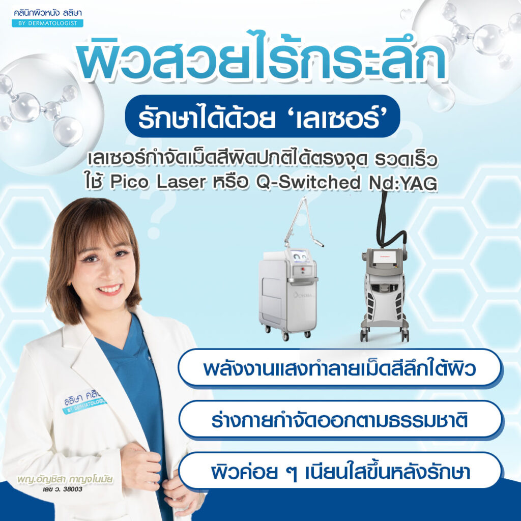 เลเซอร์กระลึก