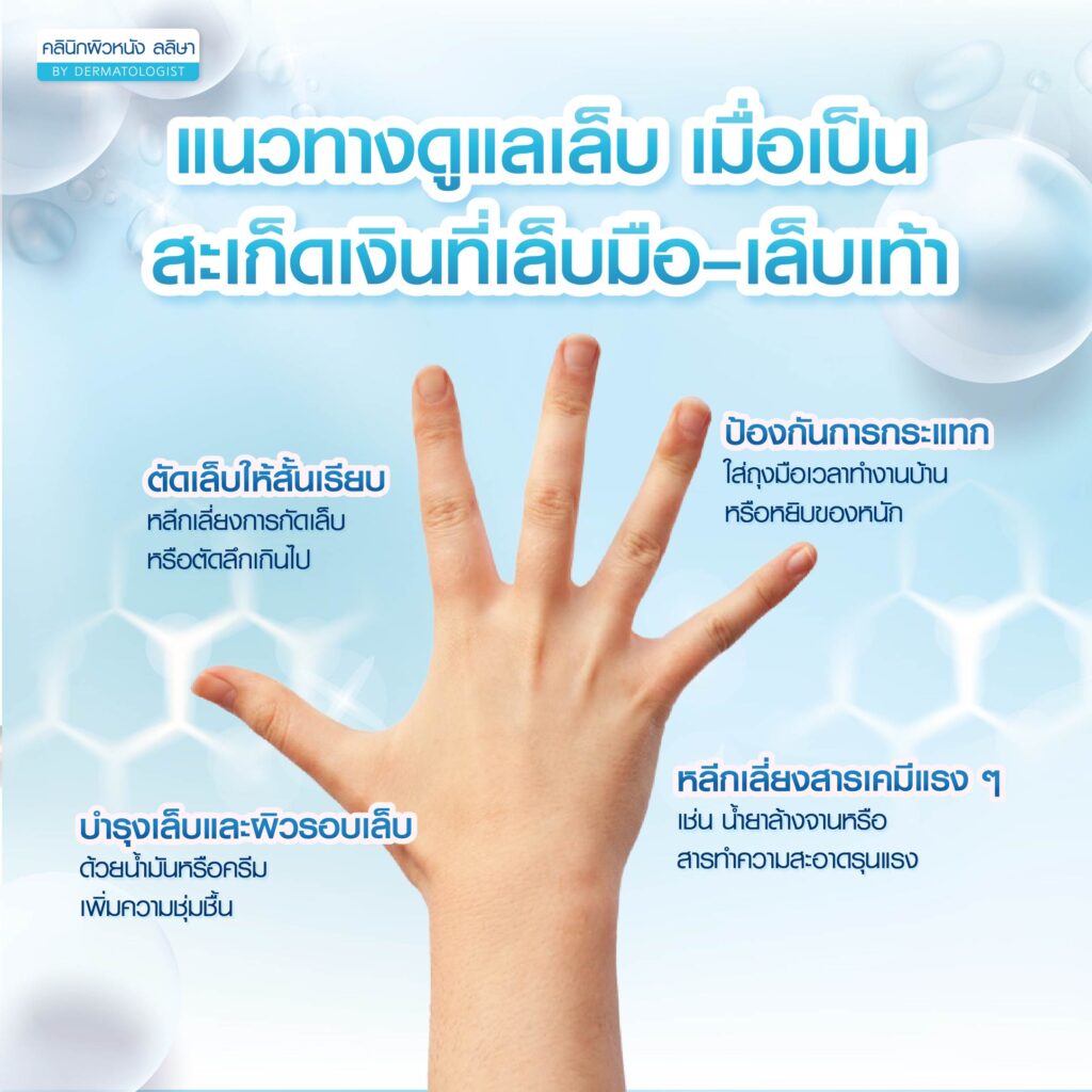 แนวทางดูแลเล็บเมื่อเป็นสะเก็ดเงินที่เล็บมือและเล็บเท้า