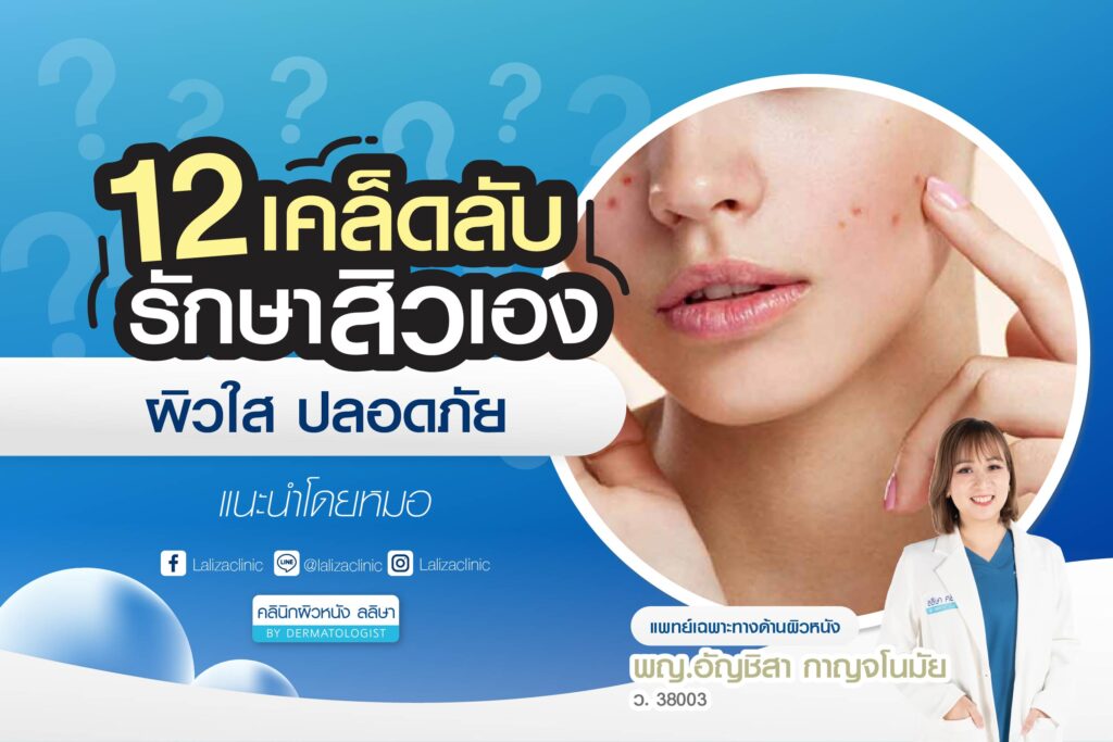 12 วิธีรักษาสิว อย่างปลอดภัย ลดสิวได้โดยไม่ทำร้ายผิว