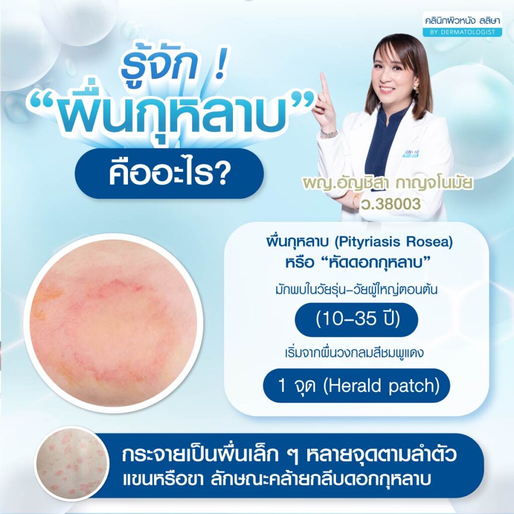 ความหมาย ผื่นกุหลาบ