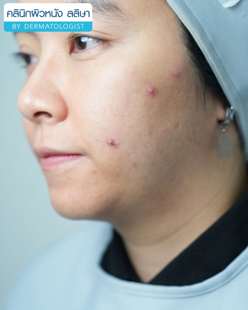 ความหมาย สิวผู้ใหญ่ (02)