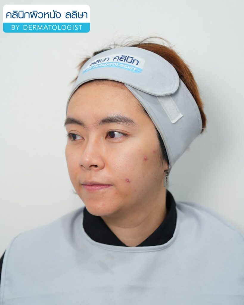 ความหมาย สิวผู้ใหญ่