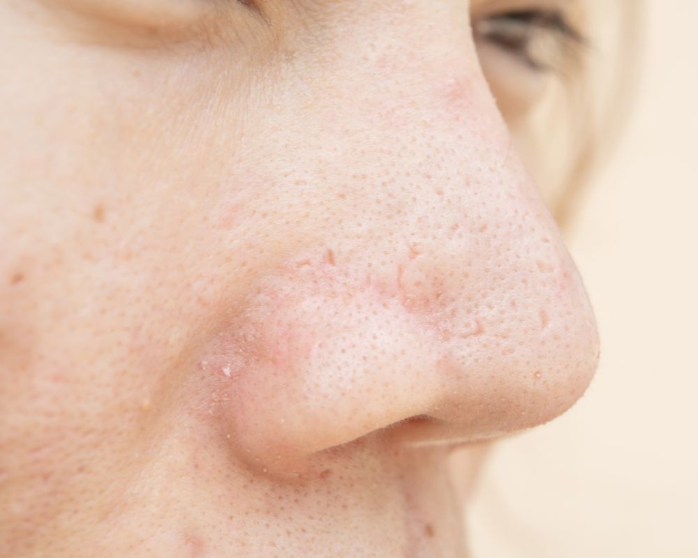 ความหมาย หลุมสิวที่จมูก